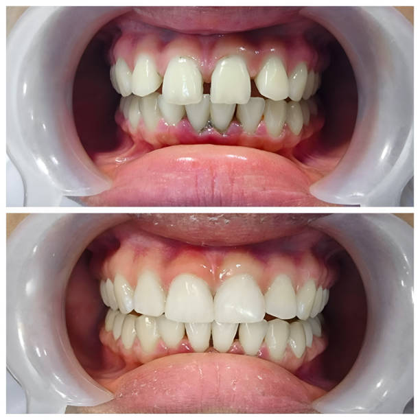 Full Mouth Reconstruction in Royal Palm Estates, FL